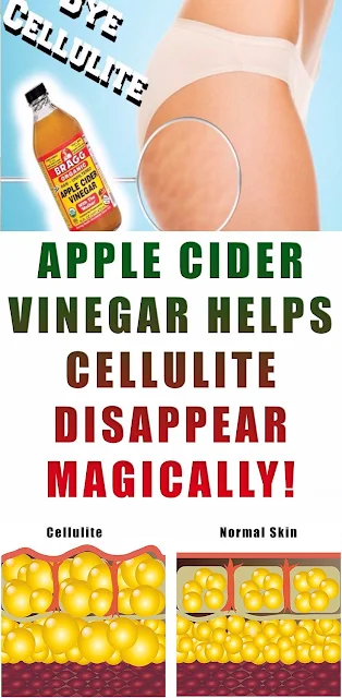 Apple Cider Vinegar Helps Cellulite Disappear Magically!