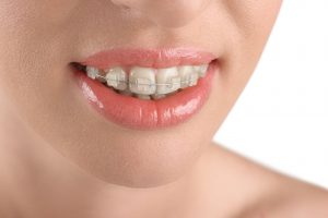 Đặc điểm của các loại niềng răng-4