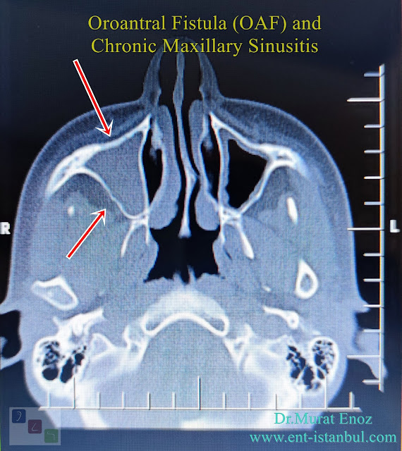 Chronic Maxillary Sinusitis,Oroantral fistula, OAF,Dental Sinusitis, Odontogenic Sinusitis,