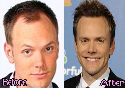 Joel-McHale-Plastic-Surgery