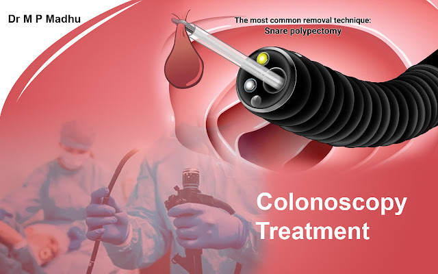 Colonoscopy in Jayanagar