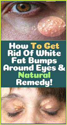 How To Get Rid of White Fat Bumps Around Eyes Naturally