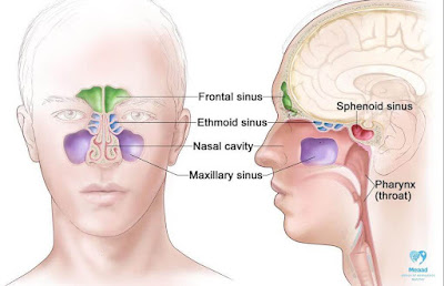 Chronic sinusitis photo