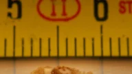 Nonsurgical Removal of Kidney Stones - How to Remove 8mm Kidney Stone Naturally