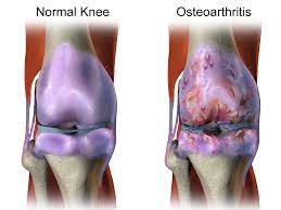Causes of Knee pain