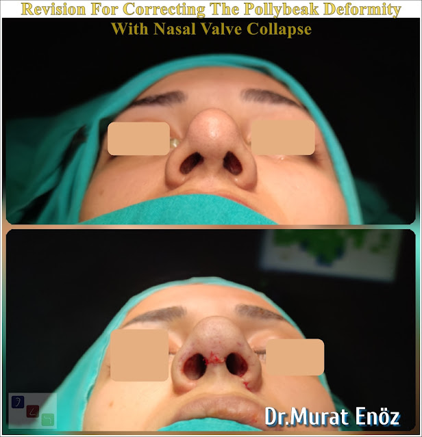 Nasal valve collapse, Pollybeak Deformity, Polly Beak Nose Deformity,