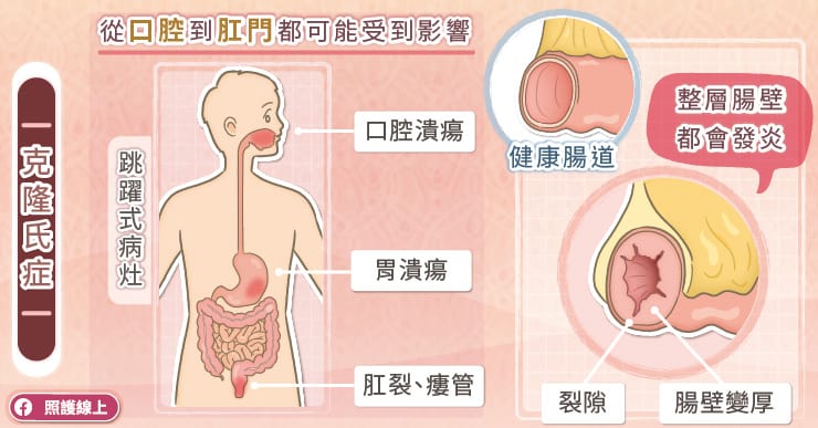 從口腔到肛門都可能受影響