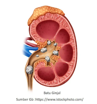 Batu ginjal berbentuk kristal yang tidak dapat larut.dengan kandungan ; kalsium oksalat, asam urat, dan kristal kalsium fosfat.   Endapan ini terbentuk jika seseorang terlalu banyak mengonsumsi garam mineral dan kekurangan minum air serta sering menahan kencing.   Upaya mencegah terbentuknya batu ginjal dengan cara : meminum cukup air putih setiap hari,  membatasi konsumsi garam karena kandungan natrium yang tinggi pada garam dapat memicu terbentuknya batu ginjal,  tidak sering menahaan kencing.  Batu ginjal yang kecil dapat saja keluar melalui urine, tetapi seringkali menyebabkan rasa sakit. Batu ginjal berukuran besar memerlukan operasi untuk mengeluarkannya.