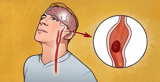 Señales de alerta temprana de un accidente cerebrovascular que todo mundo debería saber
