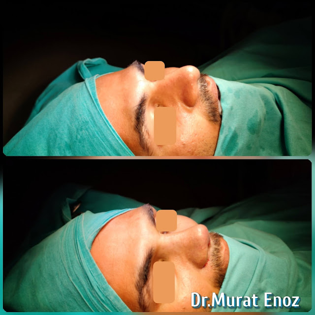 Natural nose aesthetic surgery for male,Male thick skinned rhinoplasty,Ethnic expert rhinoplasty surgeon,Ethnic Rhinoplasty in Istanbul,