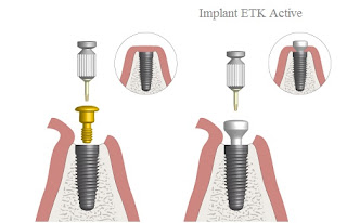 Quy trình cấy ghép răng implant-2