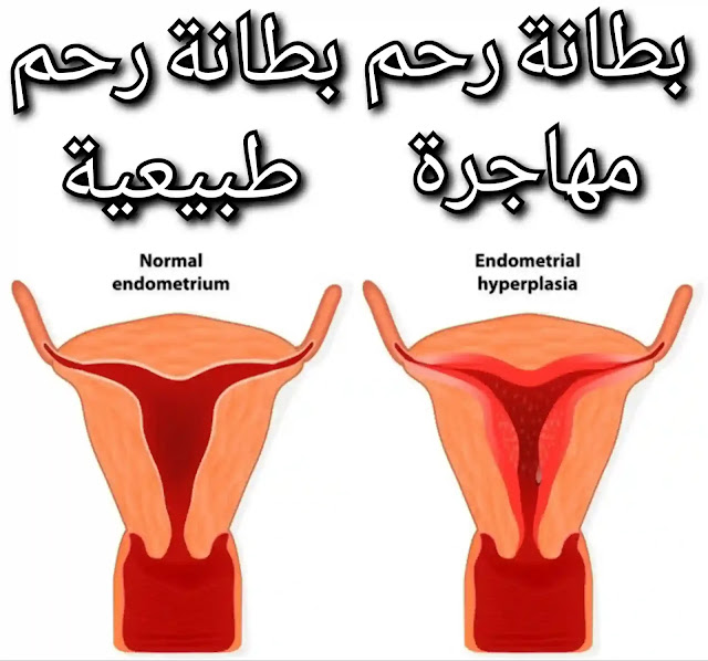 هل بطانة الرحم المهاجرة تمنع الحمل ؟