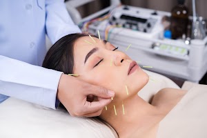 Todo lo que debes saber sobre los beneficios de la acupuntura en la salud 