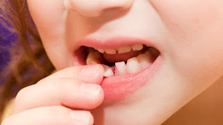 Nha sĩ khuyến cáo cần nhổ răng sữa cho trẻ đúng cách-2