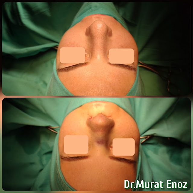 nose job,Natural rhinoplasty in Istanbul,Natural looking nasal aesthetic surgery,nose reshaping,