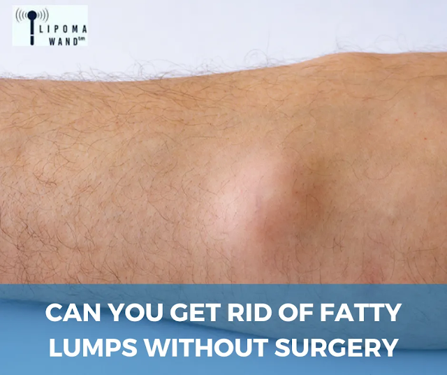 How to Get Rid of Fatty Tumors without Surgery?