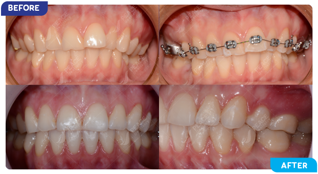 niềng răng invisalign là gì, quy trình niềng răng invisalign, Nha Khoa Peace,niềng răng invisalign, niềng răng trong suốt, niềng răng mắc cài sứ trong suốt,niềng răng mắc cài mặt lưỡi, niềng răng mắc cài kim loại, niềng răng không mắc cài Invisalign