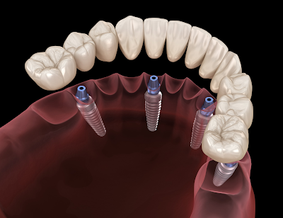 What is osseointegration