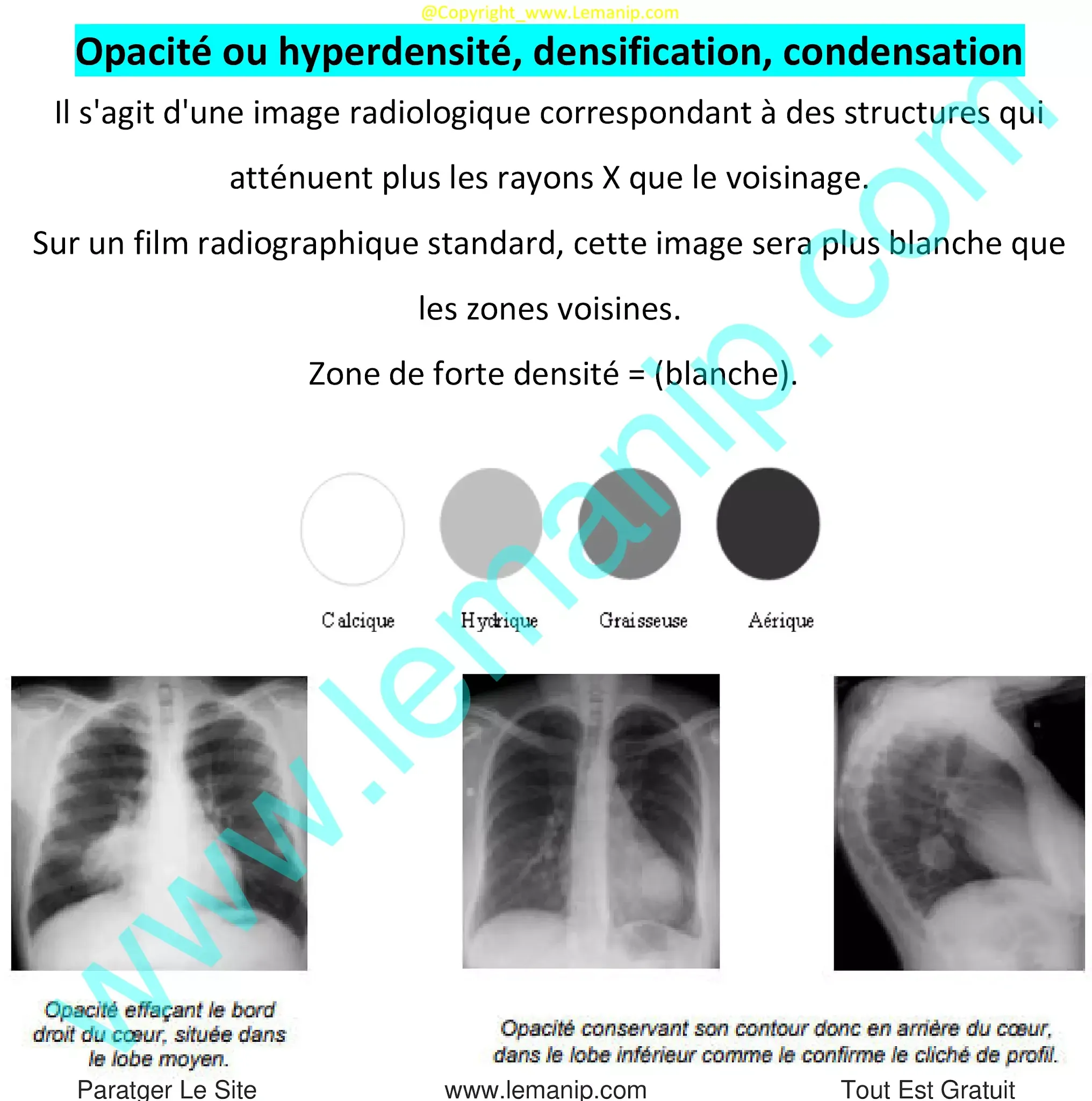 Opacité ou hyperdensité, densification, condensation