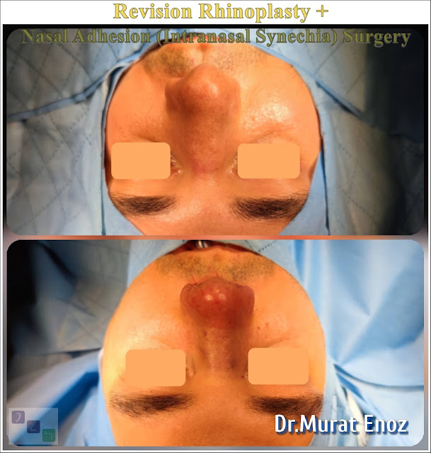 Intranasal Synechia, Revision Nose Job in Men Istanbul,Complicated Secondary Revision Rhinoplasty, Nasal Septal Spur Removal,bone spur formation,