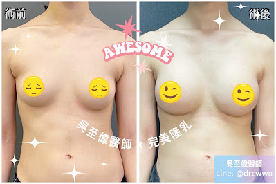 術前右胸較小，左胸較大，相差接近三分之二個罩杯，在接受魔滴隆乳手術後，雙側胸部對稱，柔軟，且自然律動
