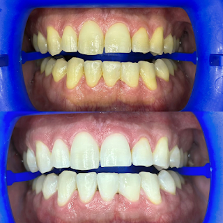 ivan-rodriguez-gelfenstein-blanqueamiento-dental-zoom-philips-teeth-whitening-tijuana-dentists-near-me-san-ysidro-chula-vista-san-diego-los-angeles