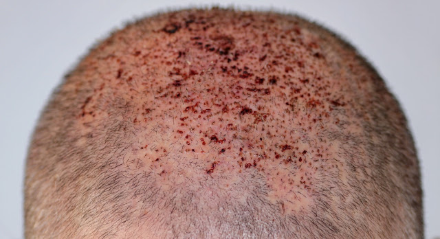 La testa di un signore una settimana dopo il trapianto di capelli che ha subito una lieve infezione nella zona dove sono impiantati i follicoli