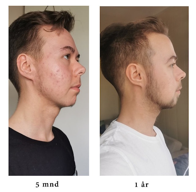 Levis ansikt fra siden etter 5 måneder med minoxidil sammenlignet med 1 år