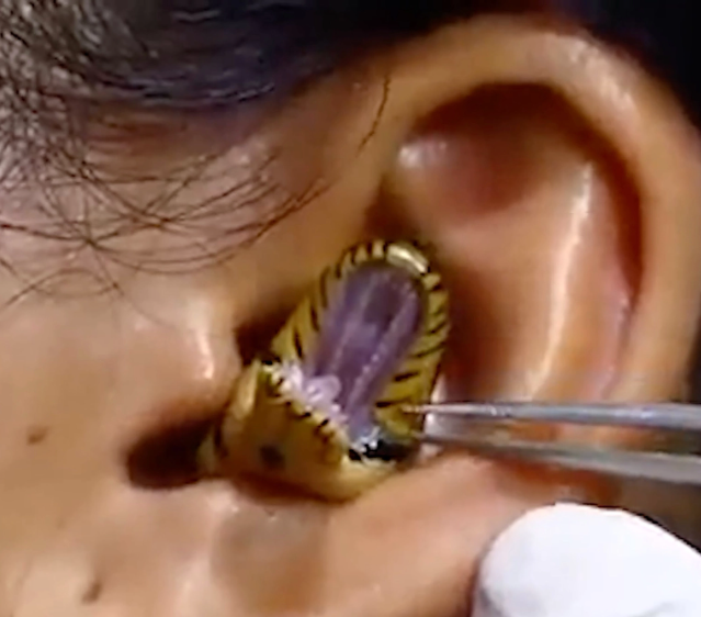 Surgeons struggle to remove live snake from woman's ear