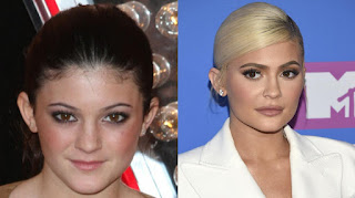 Kylie Jenner tells the whole truth about her cosmetic operations