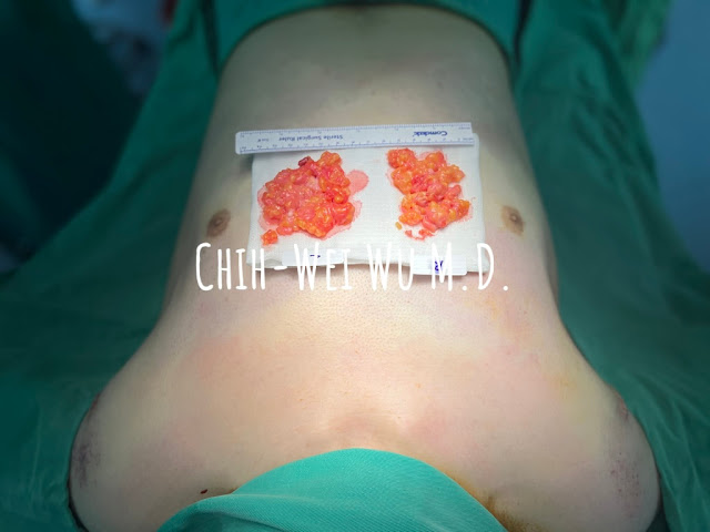 男性女乳手術後結果，透過腋下單一傷口就可以完成脂肪抽除和乳腺切除