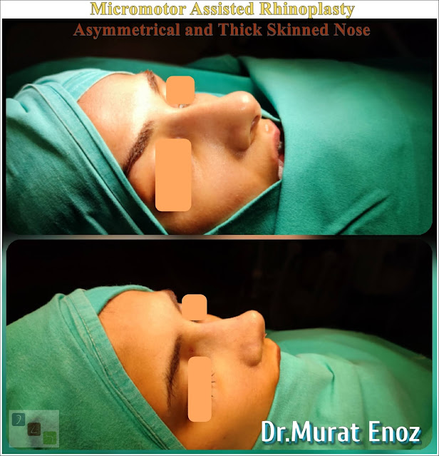 Micromotor Assisted Natural Rhinoplasty, Thick Skinned Nose Aesthetic, Hanging Columella,Drooping Columella, Female Nose Job in Istanbul,The tongue-in-groove technique