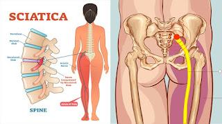 sciatica Pain  Specialist