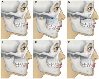 Chi phí phẫu thuật hàm hô-2