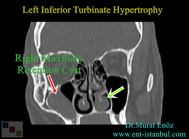 turbinate hypertrophy + right maxillary retention cyst