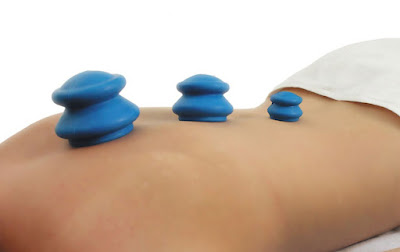 Suction Cupping Therapy