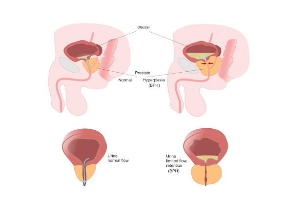 enlarged prostate treatment in Kolkata