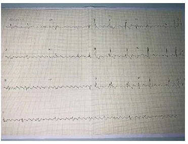 Analisando o eletrocardiograma e as alternativas a seguir, qual é o ritmo predominante mais provável que se apresenta?