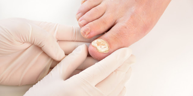 How To Heal Fungal Infections?