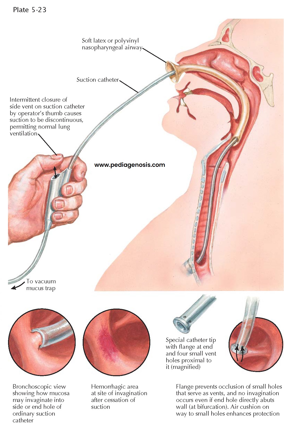 ENDOTRACHEAL SUCTION