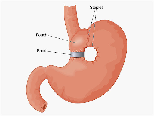 bariatric surgery Singapore