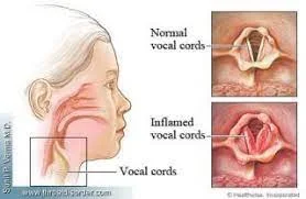 What is vocal cord spasm? What are the causes of constant burping?  What is vocal cord spasm? And what are its symptoms? And is it dangerous? What are vocal cord nodules? What is epiglottitis? What are the causes of constant burping? The answers in this comprehensive report on these cases of the larynx, in which other factors play a role, as we shall see.  A vocal cord spasm is a spasm in the muscles responsible for closing and opening the vocal cords, according to a report in Deutsche Welle.  Symptoms of vocal cord spasm The main symptoms of vocal cord spasm may be:-  -Shortness of breath due to obstruction of the airway and breathing -Cough -Heartburn -Nausea. Karen Yost was experiencing shortness of breath and suffocation, which caused her to feel frightened. After reviewing a specialized doctor, she discovered that she suffers from a defect in the vocal cords. Doctor Kane, who examined Karen, told Deutsche Welle, "When there is a defect in the vocal cords, we cannot talk about hoarseness or a problem with pronunciation, but rather this condition causes shortness of breath that occurs suddenly because the vocal cords close from one moment to another, which leads to a feeling suffocation patient.  But diagnosing the disease is not so easy, especially with the similarity of its symptoms with those of other diseases such as asthma. The patient needs to see a specialist doctor in order to make the correct diagnosis.  There are other cases that also cause an imbalance in the vocal cords, as Mariana Krumer, who also suffers from these symptoms, told Deutsche Welle that her suffering began when she went to sleep. I wake up in it from a deep sleep after feeling great fear of apnea."  The German doctor Ken indicates that Mrs. Cromer's disease was due to an increase in the intestinal acid that extended to the vocal cords, and her lungs were facing the rise of this acid through the closure of the vocal cords. And the doctor succeeded in treating Cromer's suffering after he ordered her to stop taking heart-causing drugs, such as cortisone.  As for vocal cord dysfunction, there is no drug solution for it. The disease can be treated by controlling breathing, by controlling the lips during inhalation and exhalation, in addition to exercises to increase the flexibility in the neck, which contribute to stopping the disease.  Vocal cord nodules Vocal cord nodules are nodules that develop on the vocal cords as a result of severe tissue stress, according to the German news agency, citing the German "Health Information" portal.  Teachers and singers, as well as children who scream loudly, are most likely to develop vocal cord nodules.‫‫ gate ‫‫ooodan that the symptoms of the nodules of the vocal cords are in hoarseness ‫alsot and could not speak or sing the high tones or very low.  An ear, nose and throat doctor should be consulted as soon as these symptoms are noticed. In the beginning, it is necessary to rest the vocal cords, and when the nodules do not go away, speech and language diseases are used, and in severe cases, surgery may be required.  Epiglottitis The German Association of Pediatricians and Adolescents said that epiglottitis is an inflammation caused by a bacterial infection, noting that it affects children in particular because of the sensitivity of their pharynx.  The association explained that the causes of epiglottitis are burns caused by drinking very hot liquids, infection with the germ known as "Haemophilus influenzae" and meningitis.  Symptoms of epiglottitis Symptoms of epiglottitis are:-  -Sore throat -Breathing and swallowing difficulties -Drooling from the mouth -High body temperature -A whistling sound when breathing.  Epiglottitis treatment In simple cases, the treatment is by an oxygen mask, and there is often a need to insert a breathing tube directly into the trachea, bypassing the epiglottis, to ensure an open airway if the swelling in the epiglottis increases.  In case of complete obstruction in the trachea or for another reason that obstructs the insertion of the breathing tube, it is necessary to make a surgical incision directly to the trachea in the area that follows the obstruction, and through which the patient breathes.  If epiglottitis is caused by Haemophilus influenzae, then the treatment is also with antibiotics.  The epiglottis is a small fold of tough tissue that closes the entrance to the larynx and trachea when swallowing.  What does persistent burping indicate? The German Association of Otolaryngologists said that burping from time to time is normal, stressing the need to consult a doctor when burping continues for a period of more than 4 to 6 weeks.  The association explained that continuous burping may indicate a disease such as "post-nasal drip" syndrome, which means the descent of nasal secretions from the back area of ​​the nose to the throat, and this occurs when mucus is produced in excessive quantities by the membrane. nasal mucosa.  Symptoms also include bad breath and constant sneezing. Persistent belching may also be due to gastroesophageal reflux disease, which occurs due to abnormal reflux of stomach acid into the esophagus, and its symptoms also include heartburn (heartburn) and hoarseness.  In rare cases, persistent burping can signal a tumor in the throat or larynx.  In any case, it is recommended to consult a doctor to determine the real reason behind the persistent belching, on the basis of which the treatment is determined; For example, treatment with antibiotics if the cause lies in the syndrome of "postnasal drip".  But if the cause is gastroesophageal reflux, then the treatment is with drugs that stop the secretion of acid gastric juice.