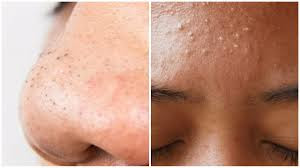 https://khgallery570.blogspot.com/2022/04/what-is-best-way-to-remove-blackheads.html