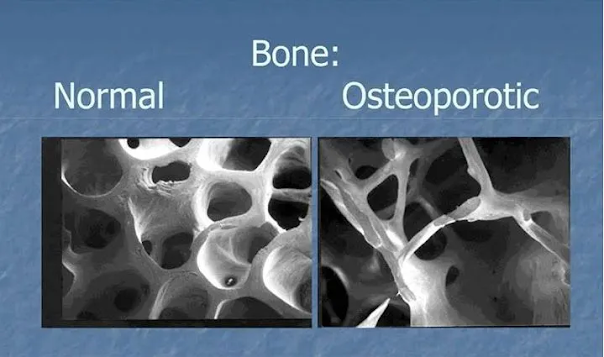 Kenali Apa Itu Osteoporosis