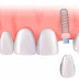 Cấy ghép răng implant là gì