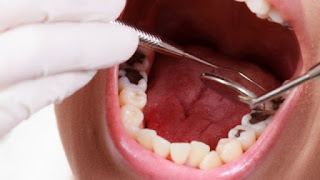 Quy trình thực hiện trám răng thẩm mỹ-2