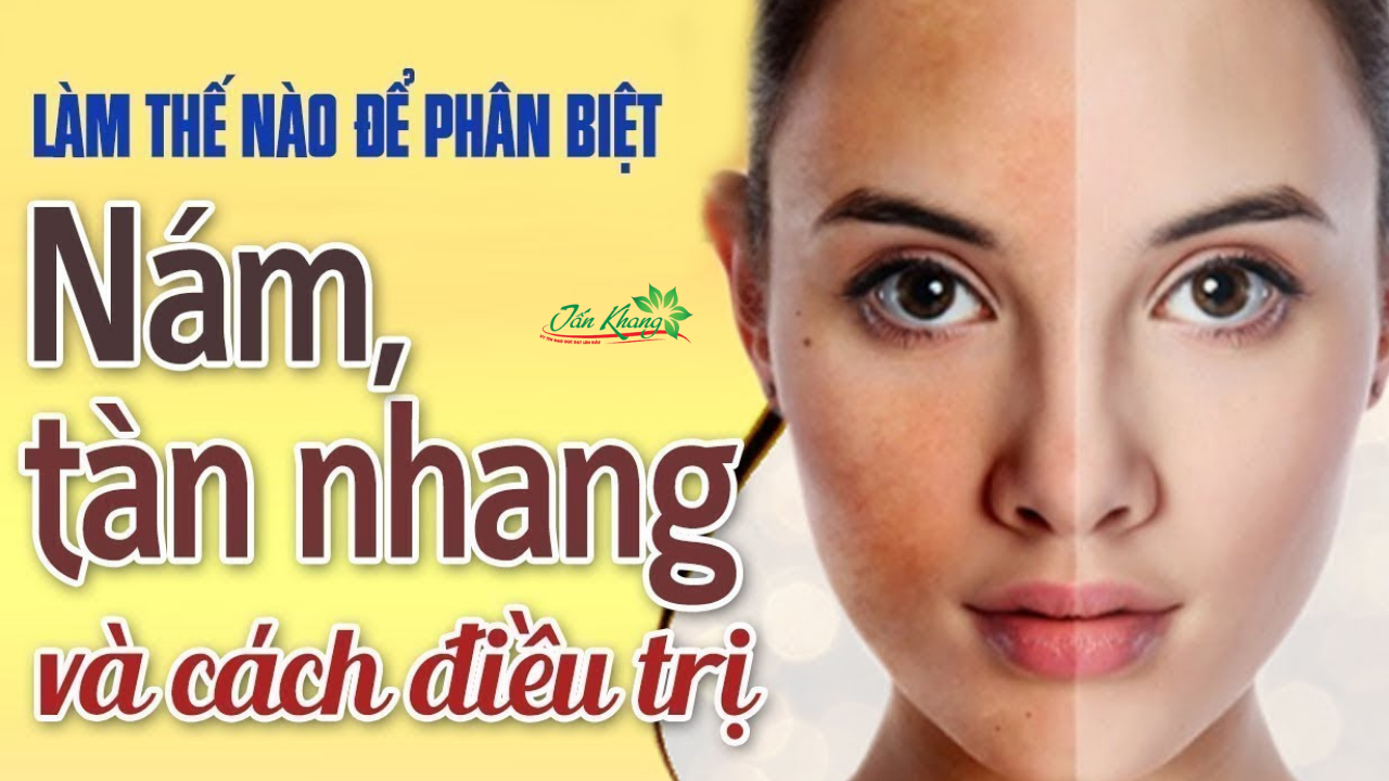 Nguyên nhân, Triệu chứng, Chẩn đoán và Điều trị nám da