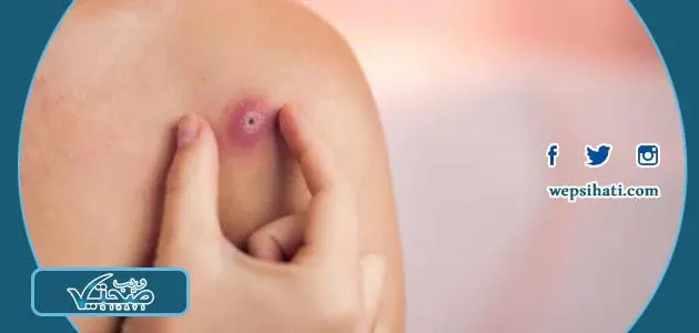 أفضل مضاد حيوي لعلاج الدمامل من الصيدلية