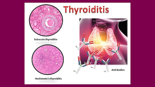 What is Thyroiditis? | Treatment for Hashimoto's Thyroiditis | 2021