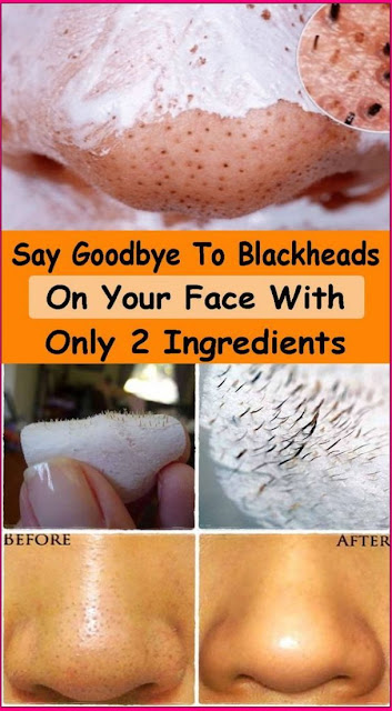 Say Goodbye to Blackheads on Your Face With Only 2 Ingredients